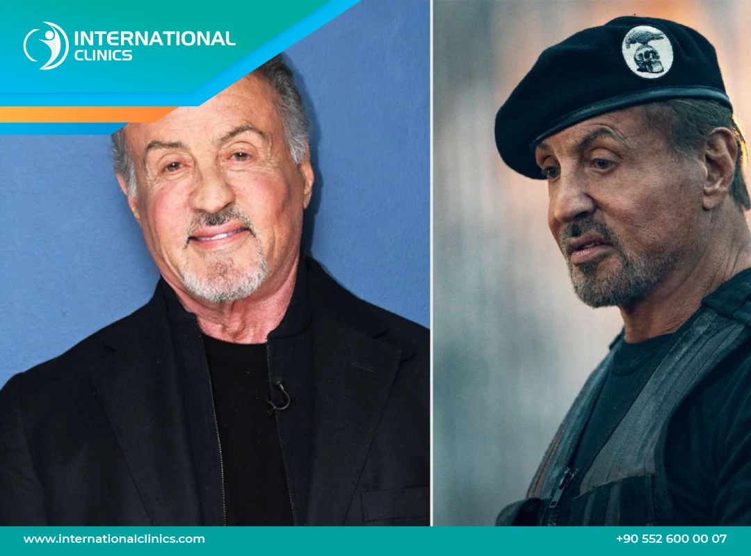 Sylvester Stallone Plastic Surgery: In Movies and Family with Before and After Images