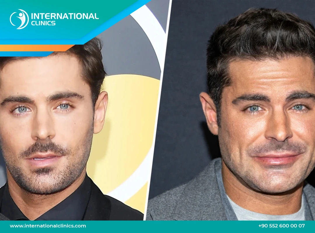 Zac Efron Face: Plastic Surgery, Injury, and Before and After Images