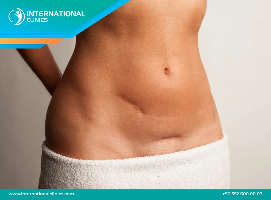 Tummy Tuck Scar: Shapes, Healing, and Treatments in 2025