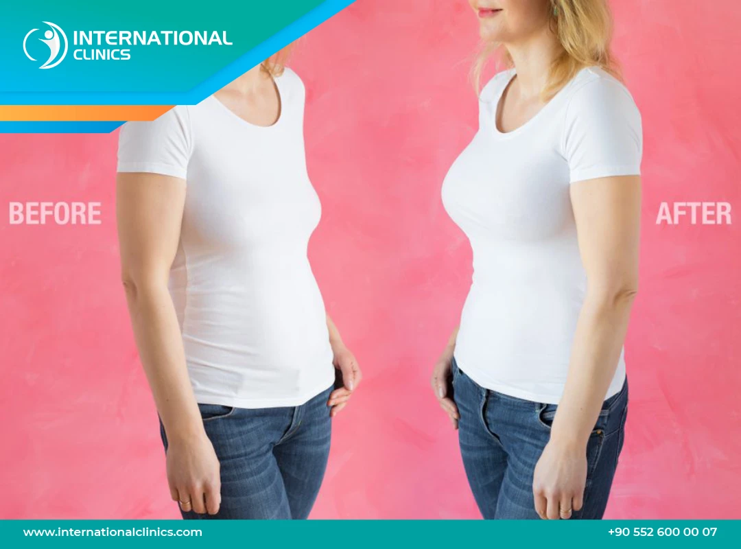 Breast Lift Before and After Images with Breast Augmentation