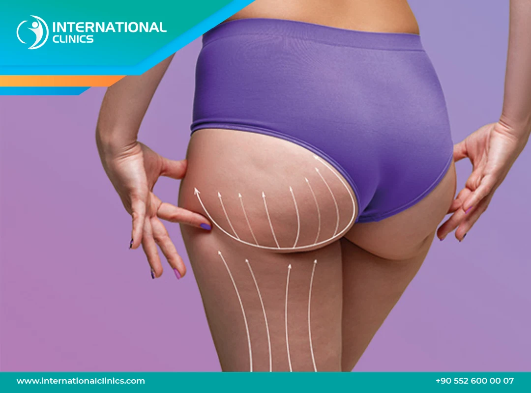 Thigh Lift in Turkey: Everything You Need to Know in 2025