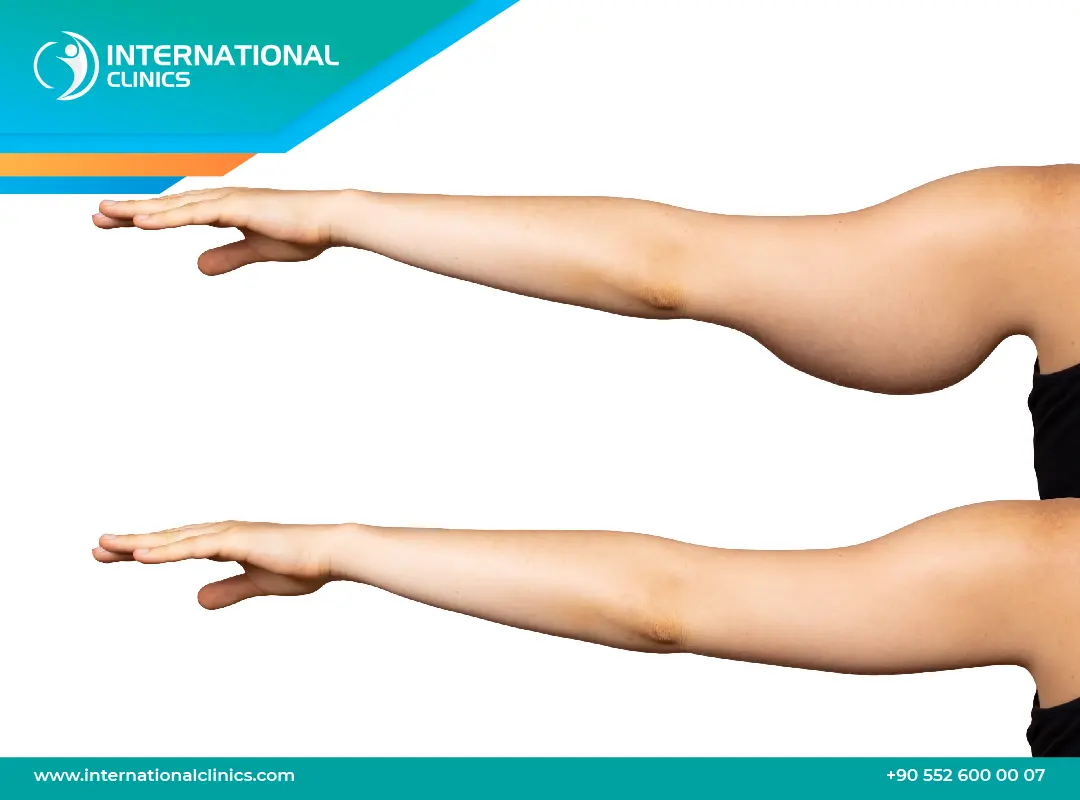 تجربتي مع عملية شد الذراعين: القصة الكاملة من التخطيط إلى النتائج الواقعية