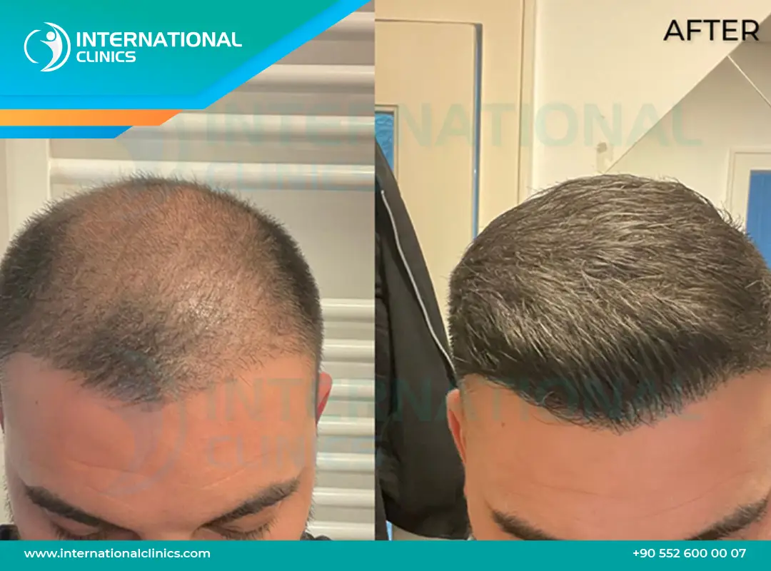 Why Do People Go Turkey for Hair Transplants?