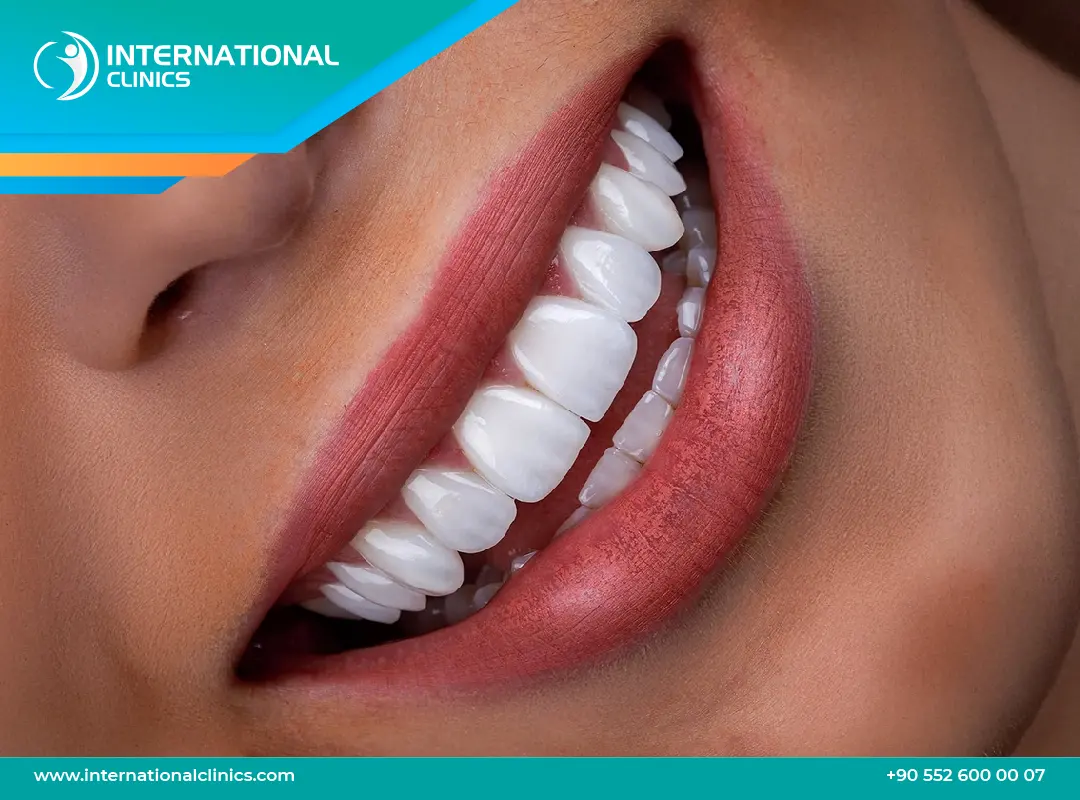 ابتسامة هوليود في تركيا: هل تمنحك ابتسامة المشاهير 2025؟