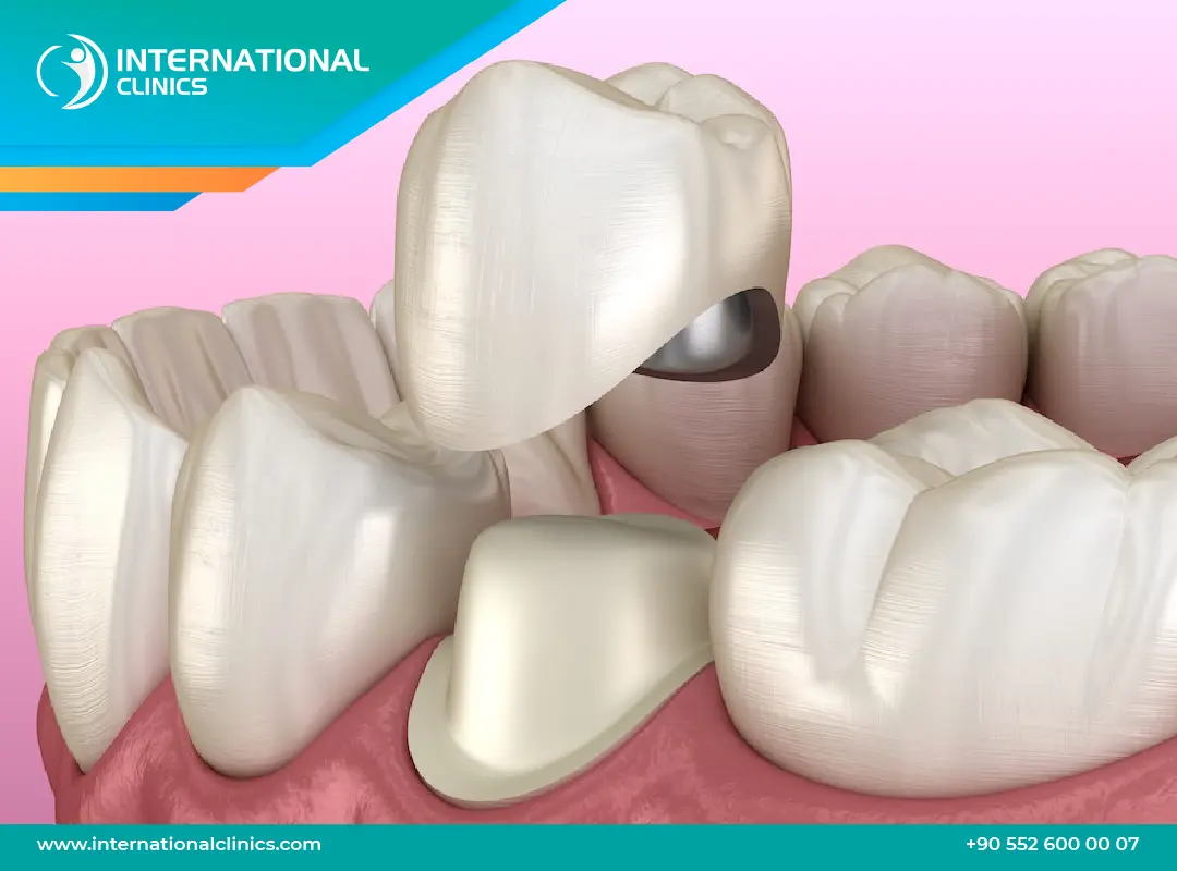 أسعار تلبيس الأسنان في تركيا: ابتسامة جديدة في أسبوع واحد!