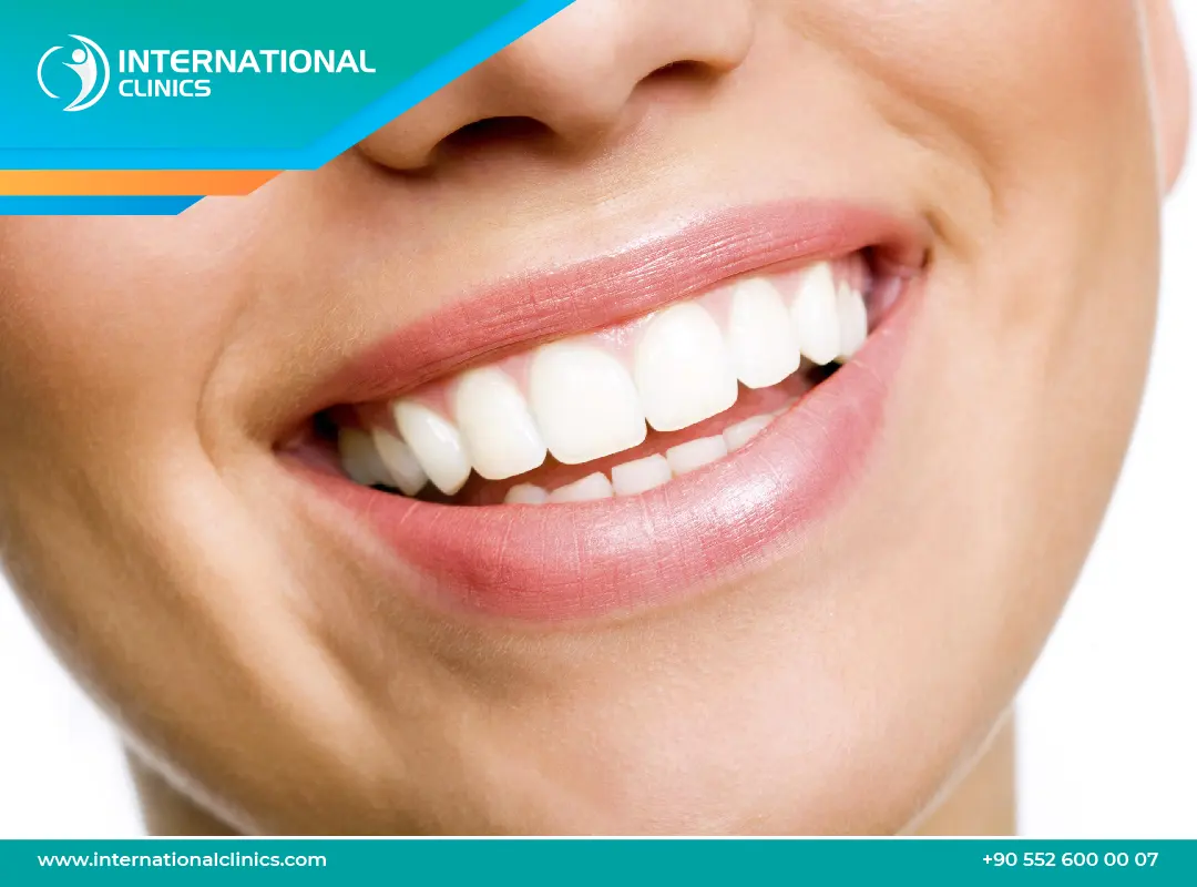تبييض الأسنان في تركيا: بياض يدوم طويلاً ويمنحك الثقة
