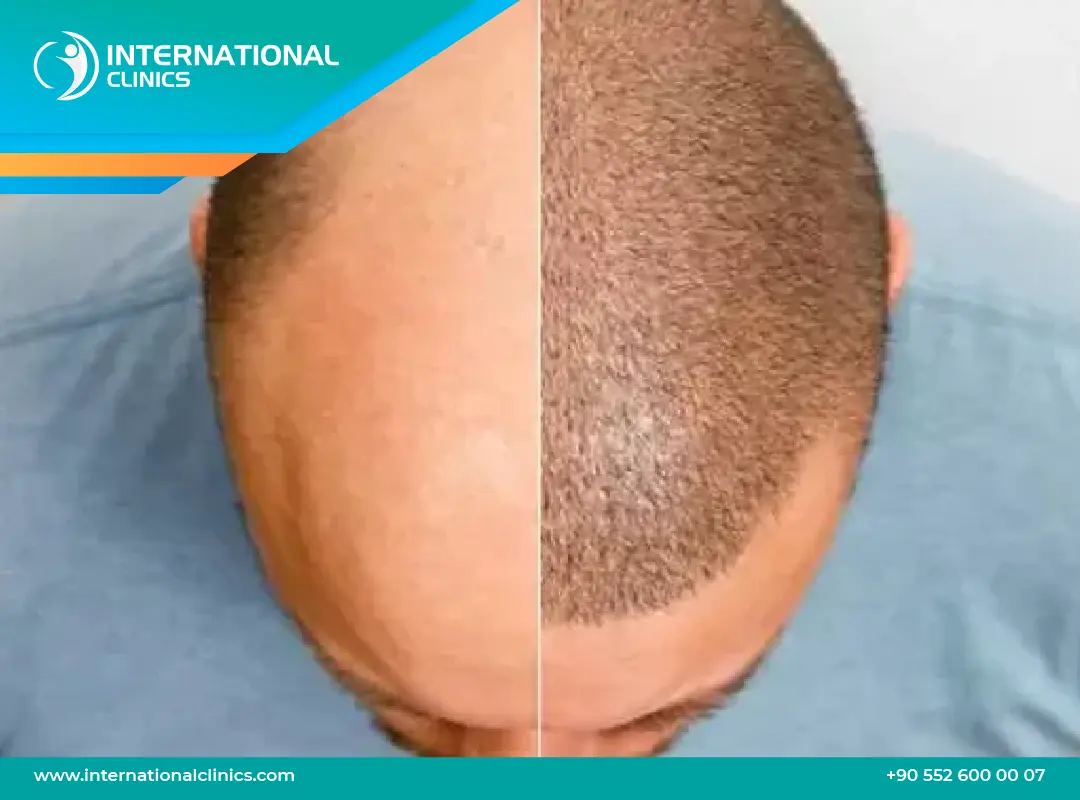 افضل مركز زراعة الشعر في تركيا: 8 معايير حاسمة