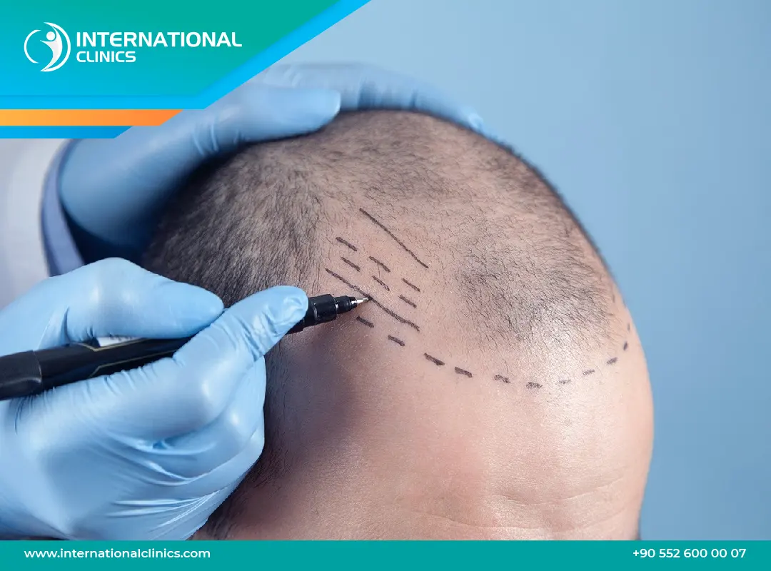 أفضل مراكز زراعة الشعر في العالم: من هو، وما دولته؟