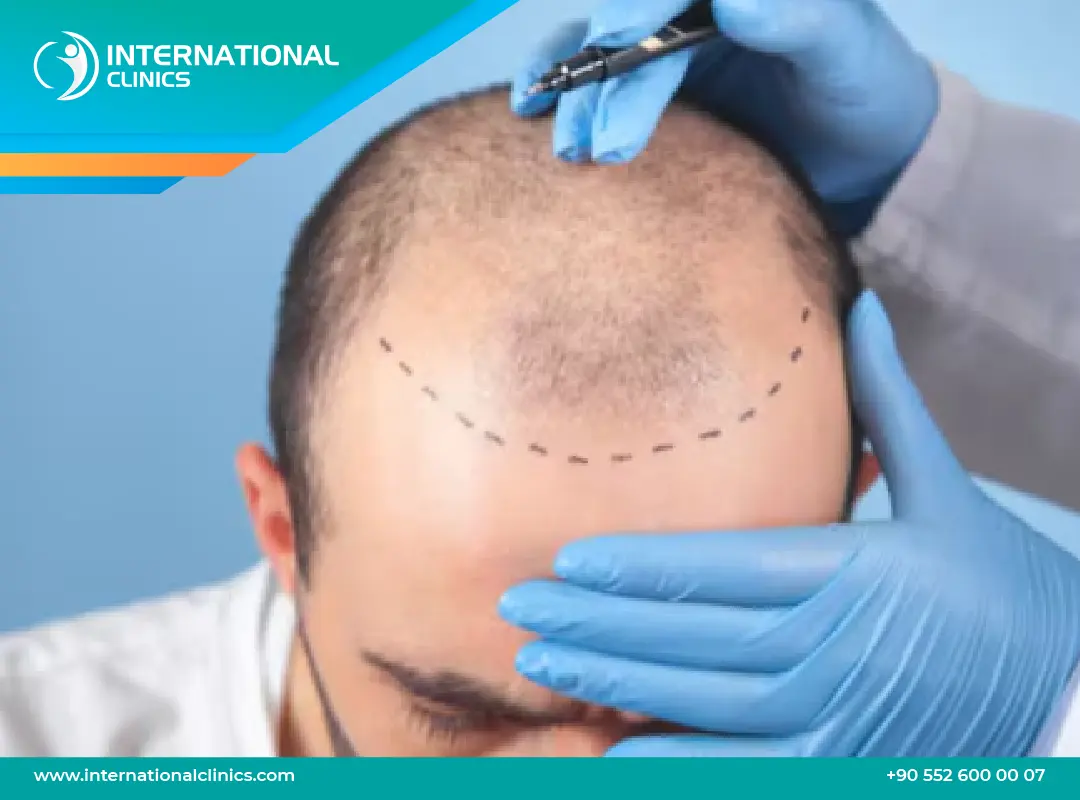 تجربتي مع زراعة الشعر: من الصلع إلى الثقة مرة أخرى