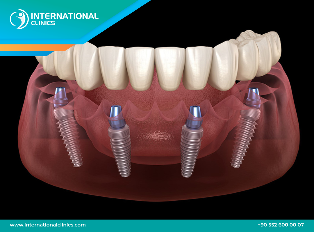 All-on-4 Dental Implants in Turkey,Permanent Teeth in Just 3 Days