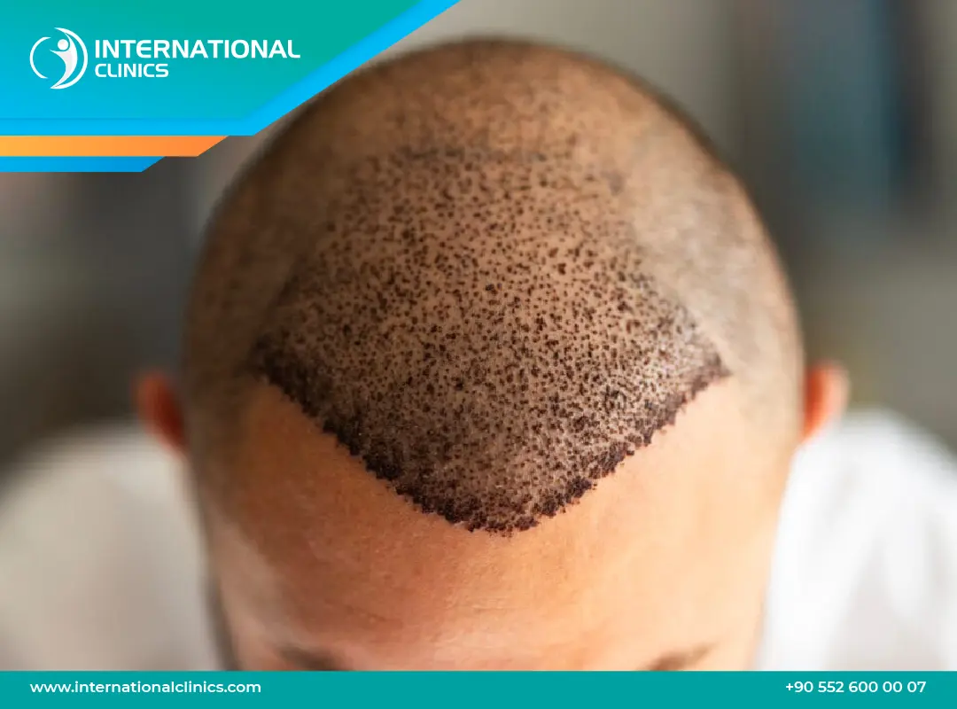 هل زراعة الشعر حرام؟ للنساء والرجال