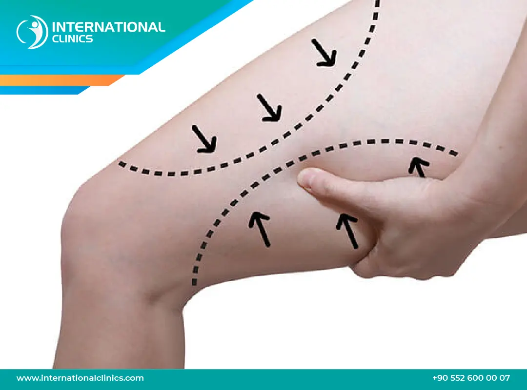 عملية شد الأفخاذ بالليزر: الحل للتخلص من الترهلات بدون مشرط