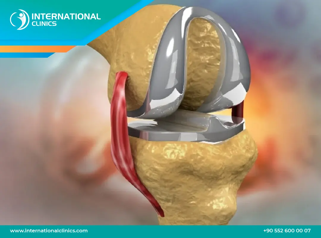 تجربتي مع تغيير مفصل الركبة: تجربة مليئة بالأمل والتعافي