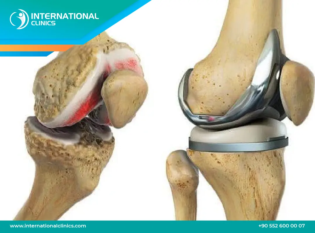 سعر عملية تغيير مفصل الركبة: استعد لحياة خالية من الألم!