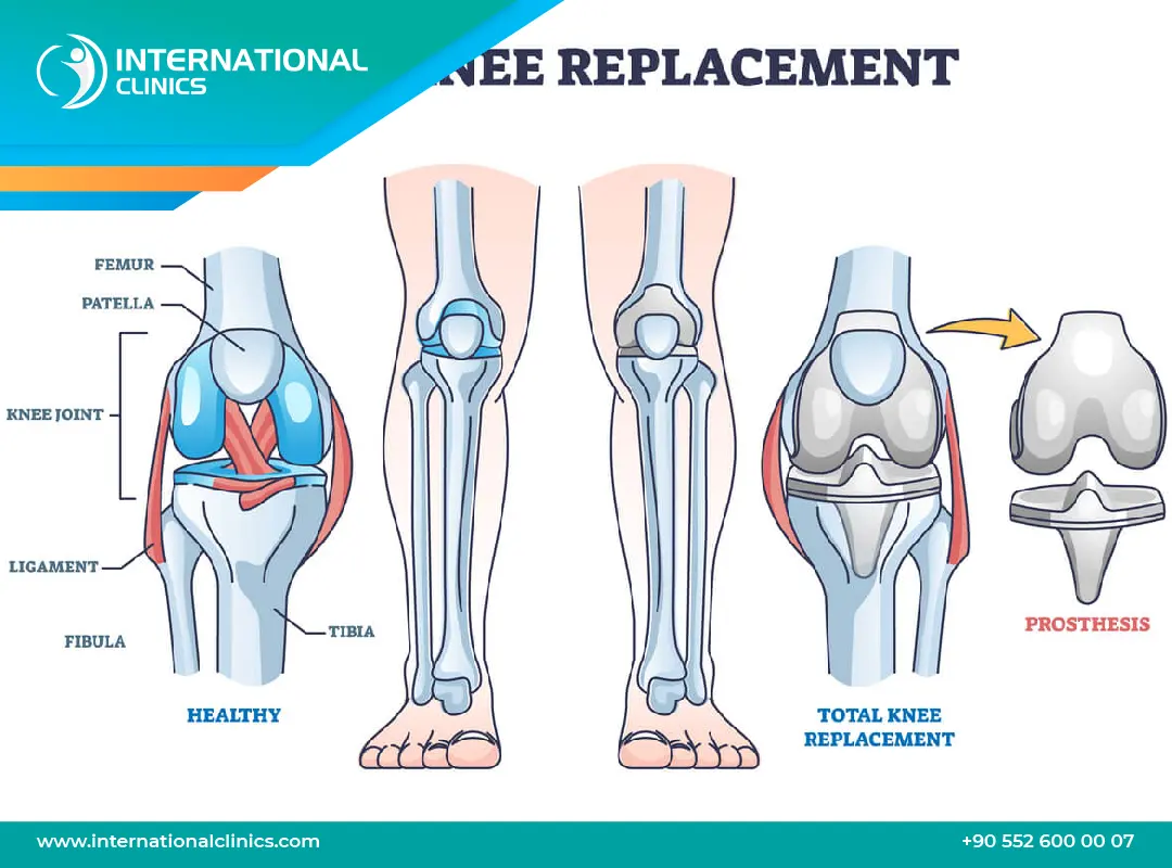 نسبة نجاح عملية تغيير مفصل الركبة: تأثيرها على حياتك