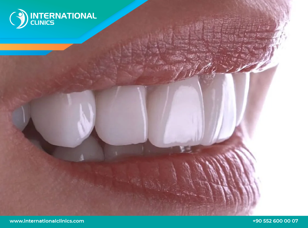 E-max Veneers in Turkey - Flawless Smile,  Pain-Free & Low Price
