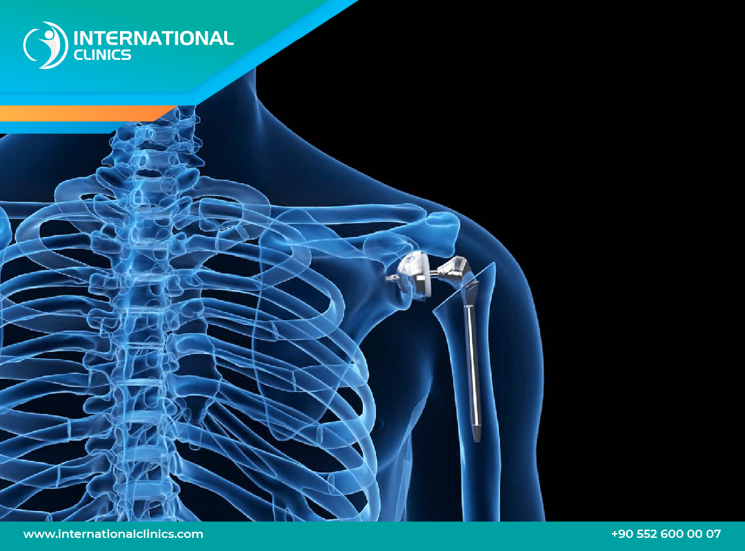 Total Shoulder Replacement in Turkey: Safe, Affordable, and Expert Care