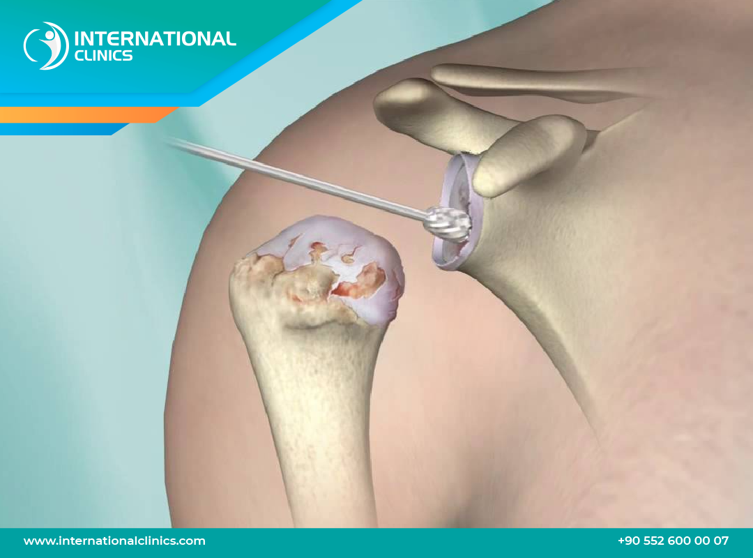 Partial Shoulder Replacement in Turkey cost &safety
