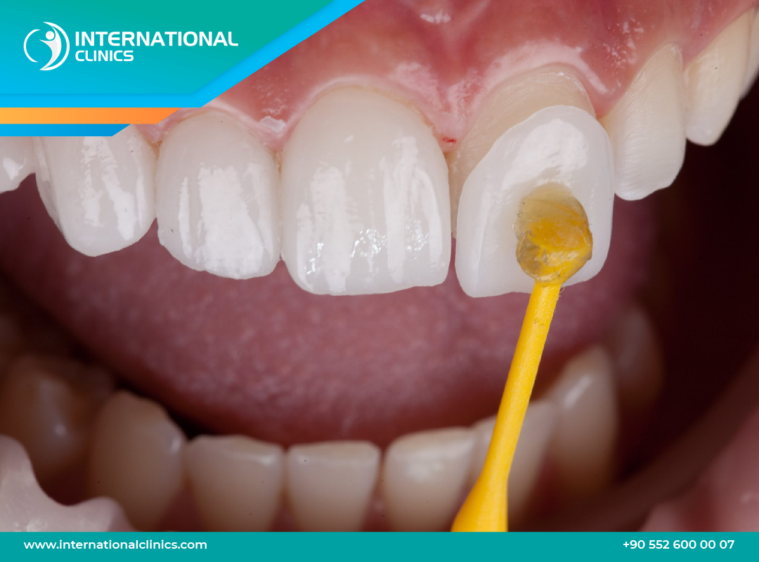 Dental Veneers in Turkey - Get a Smile Makeover with affordability