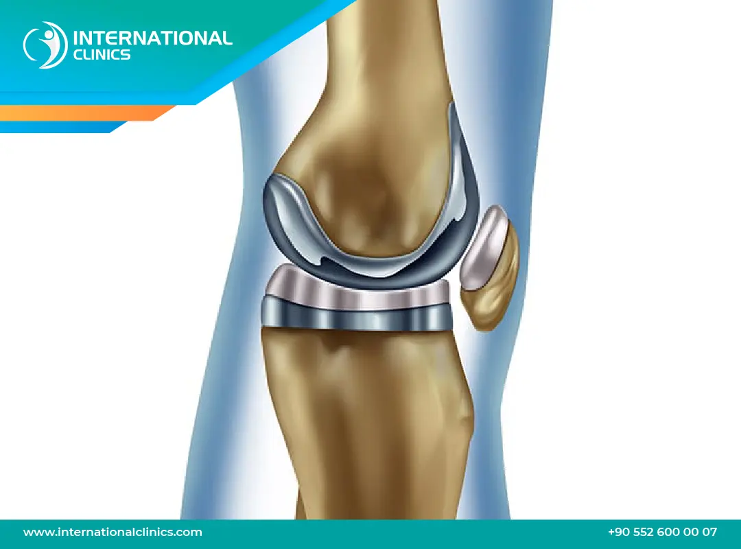 أضرار عملية تغيير مفصل الركبة: ماذا يجب أن تعرف؟