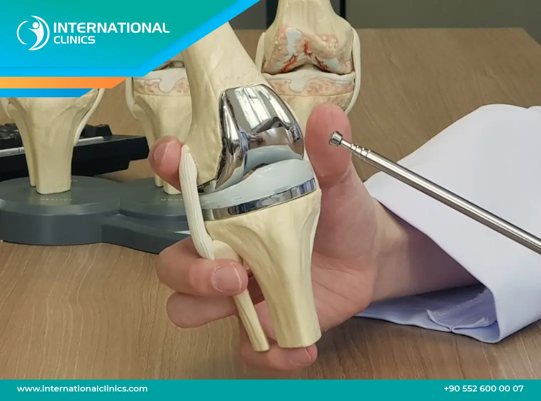 نصائح بعد عملية تغيير مفصل الركبة: للتعافي السريع