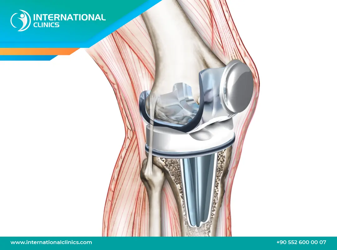 فشل عملية تغيير مفصل الركبة: اكتشف الأعراض و الأسباب والحلول