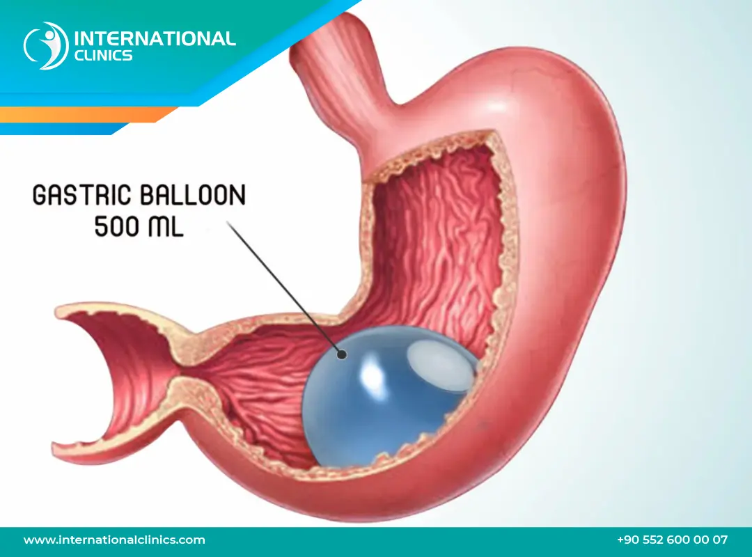 كبسولة المعدة في تركيا: رحلتك نحو جسم مثالي