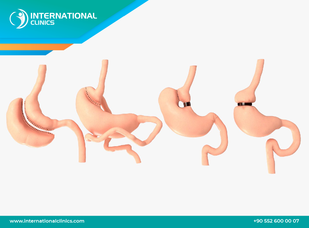 How much is a gastric bypass surgery?  Save Up to 70% of the Price