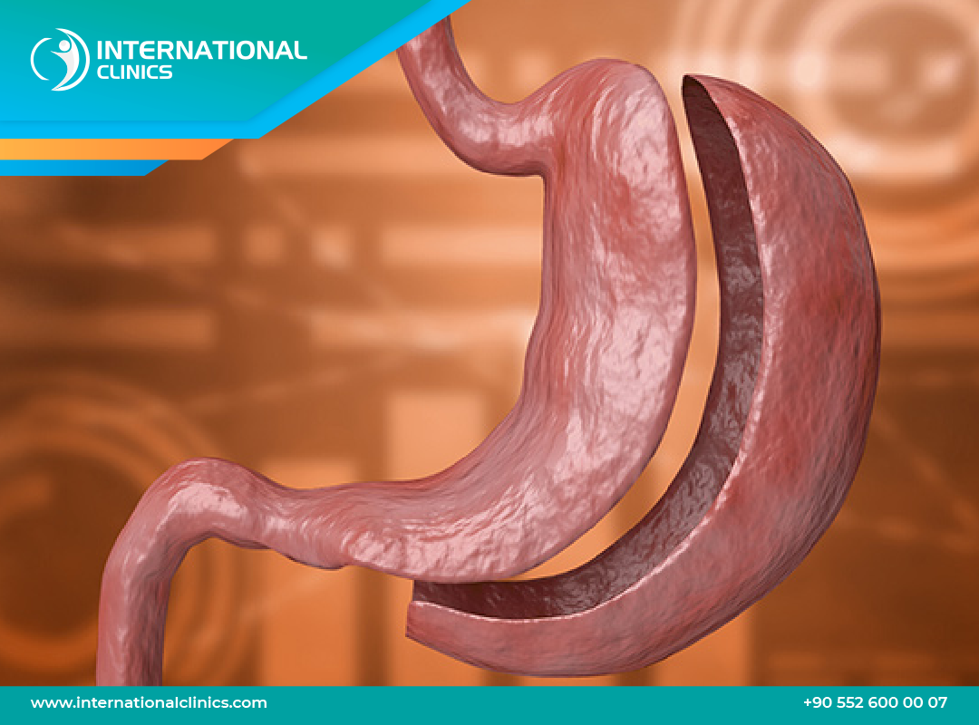 Gastric Sleeve Price in Turkey -  Get Your $2,500 Package