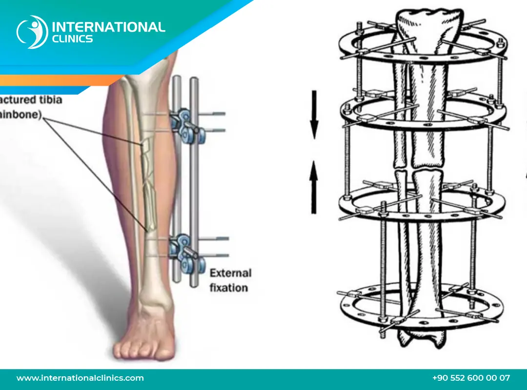 عملية زيادة الطول في تركيا: الحل الأمثل لقصر القامة