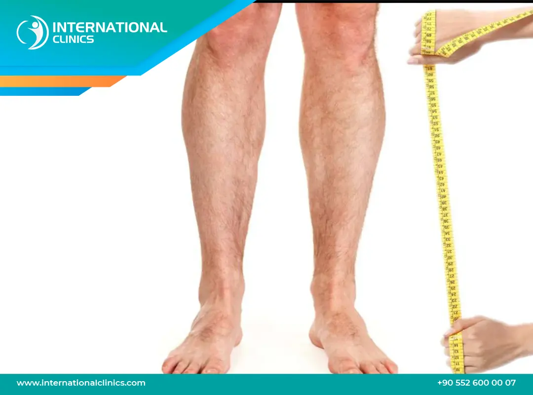 تكلفة عملية زيادة الطول في تركيا: احصل على قامة مثالية بسعر معقول!