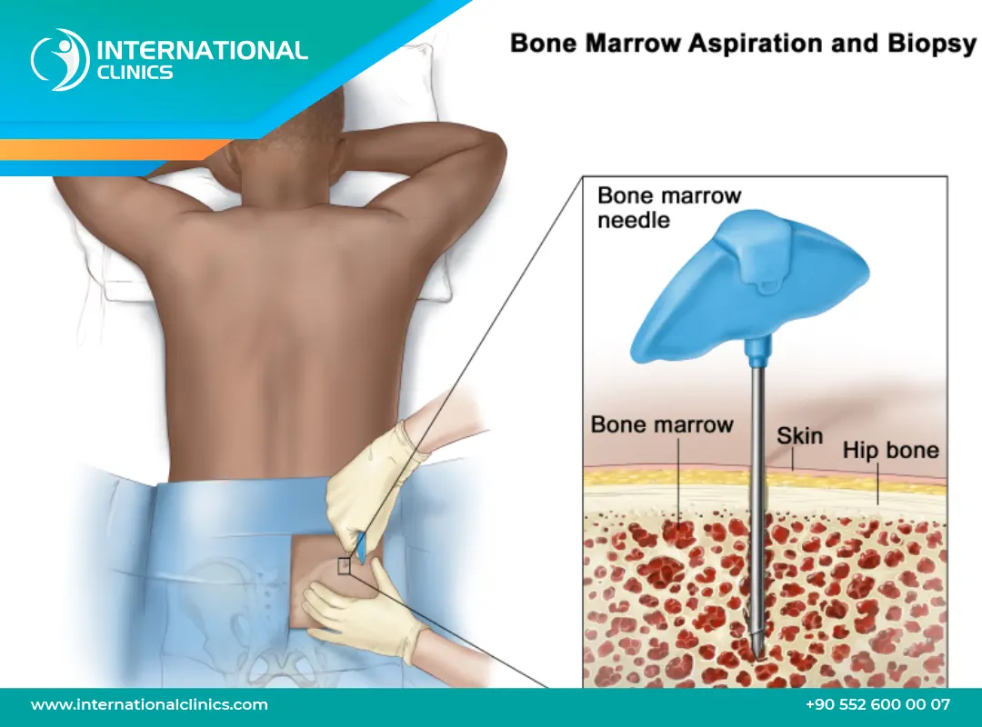 خزعة نخاع العظم: دليل شامل لتشخيص الأمراض