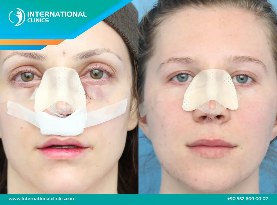 مراحل تغير شكل الأنف بعد عملية التجميل بالصور من اليوم الأول حتى 12 شهرًا