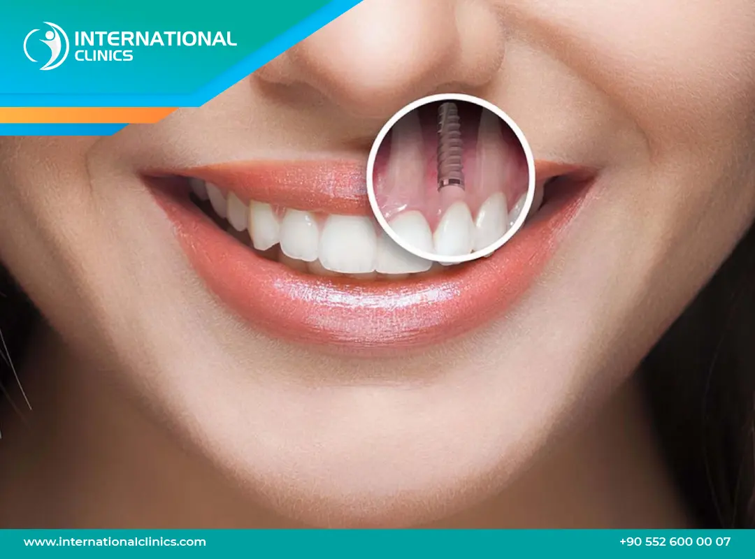 تكلفة زراعة الأسنان في تركيا: احصل على زرعات دائمة في 5 أيام فقط!