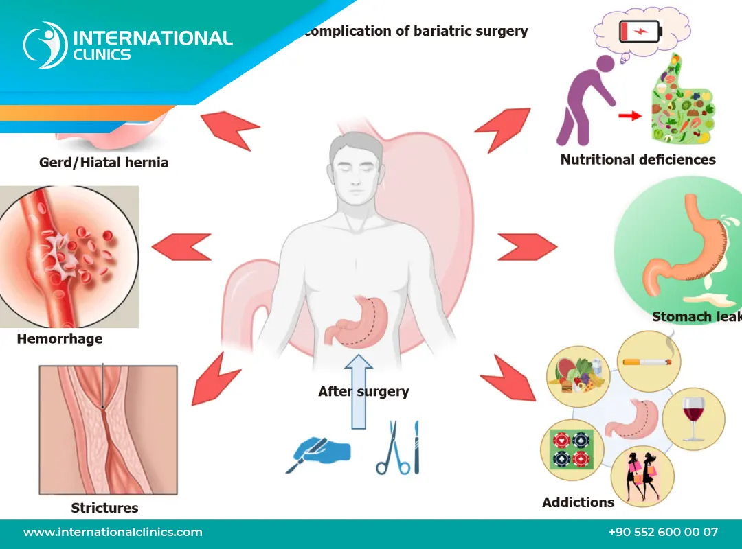 أضرار عملية تحويل مسار المعدة المصغر بالمنظار وطرق تجنبها