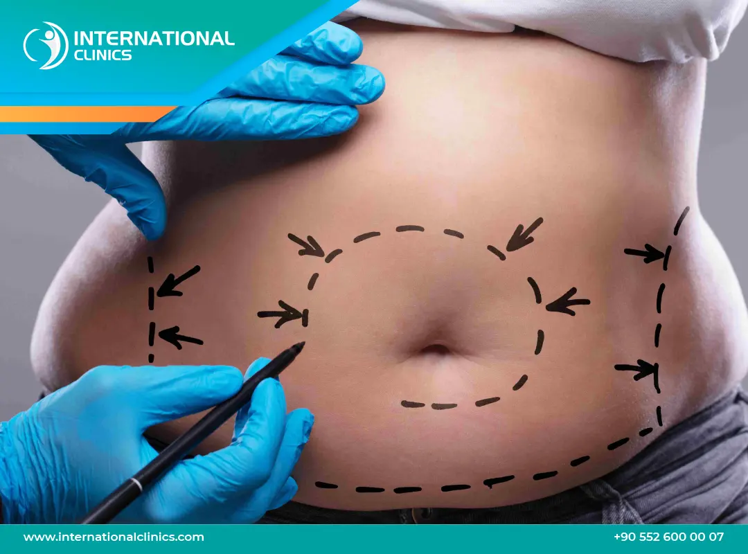 شكل السرة بعد عملية شد البطن: شكل السرة المثالي والنتائج المتوقعة