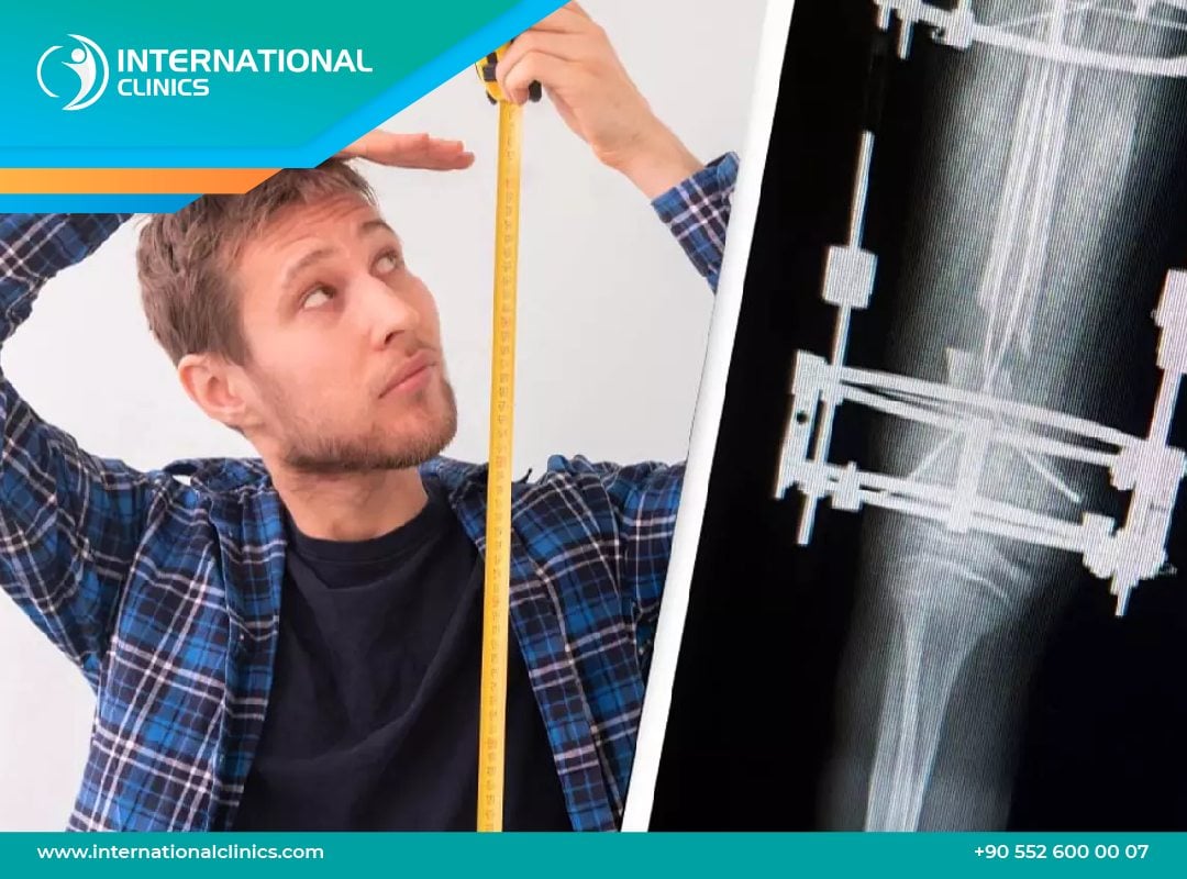 Knee Surgery to Get Taller in Turkey: Safe, and Affordable Limb Lengthening