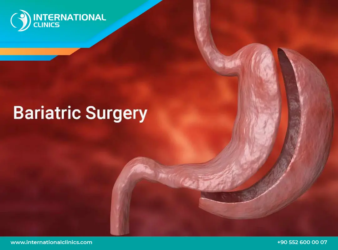 قص المعدة في تركيا: الحل الأمثل لفقدان الوزن وتحسين الصحة!