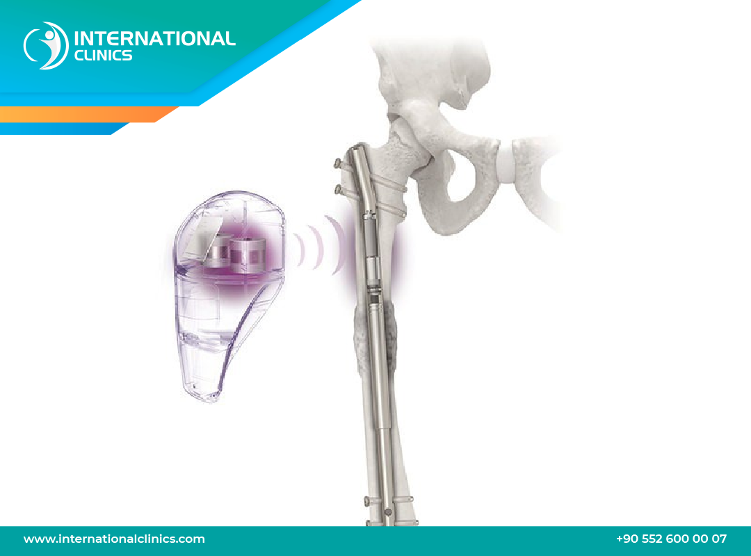 PRECICE MAX 2025: Cutting-Edge Limb Lengthening Surgery