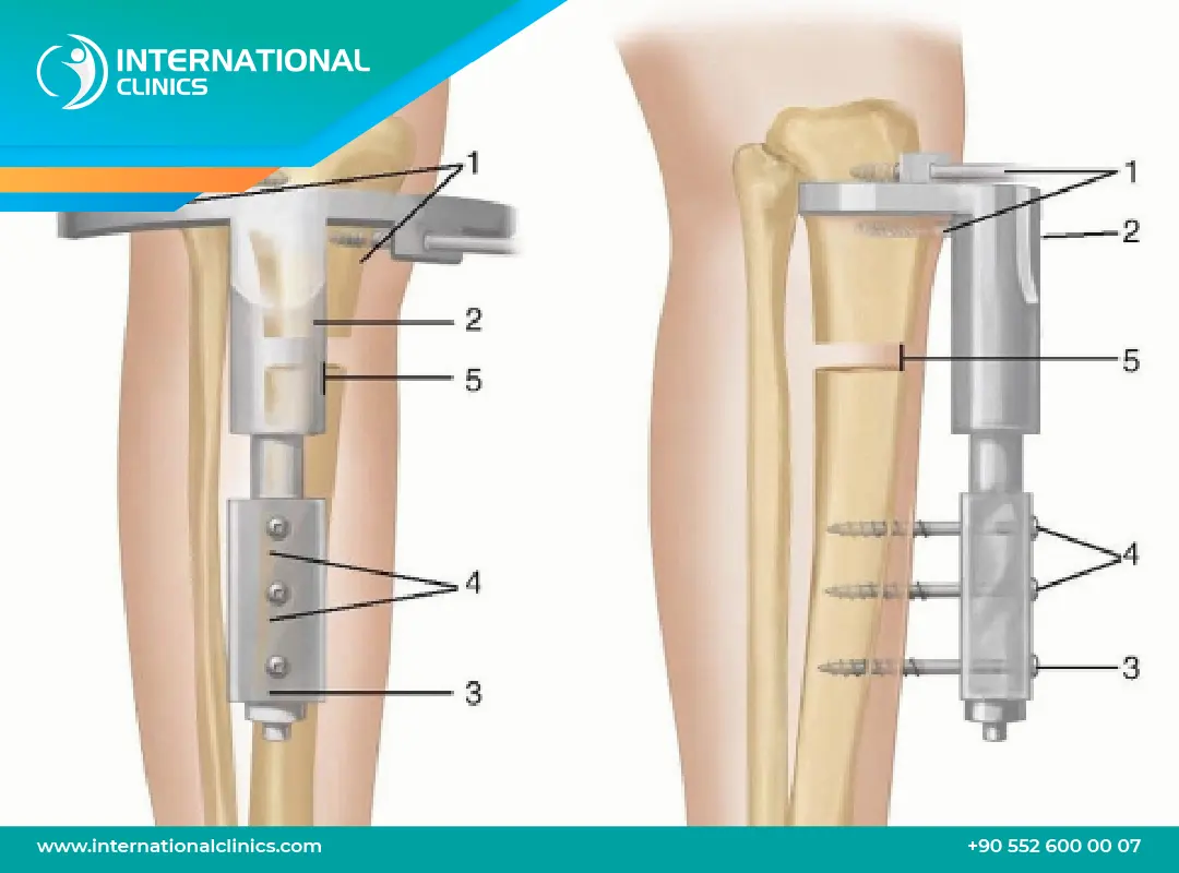 عملية تطويل القامة: الإجراءات الجراحية المتقدمة لزيادة الطول