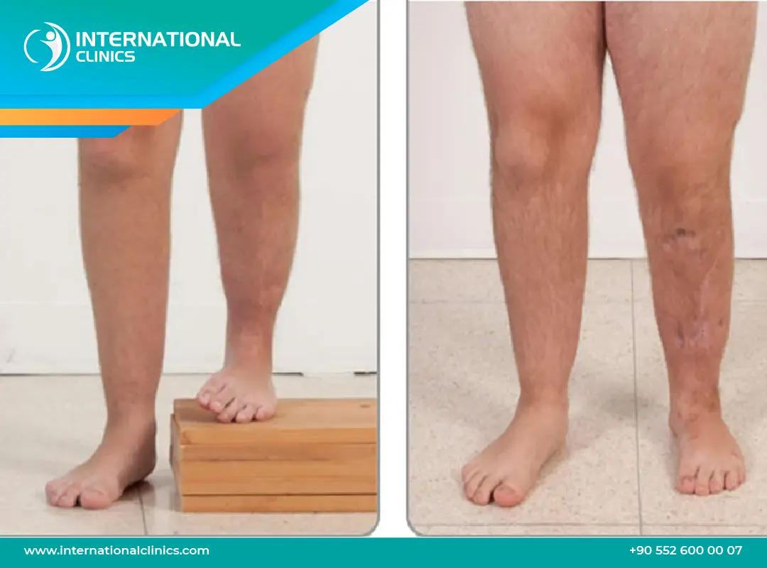 نسبة نجاح عملية تطويل القامة: السر وراء النجاح وتأثيره على النتائج