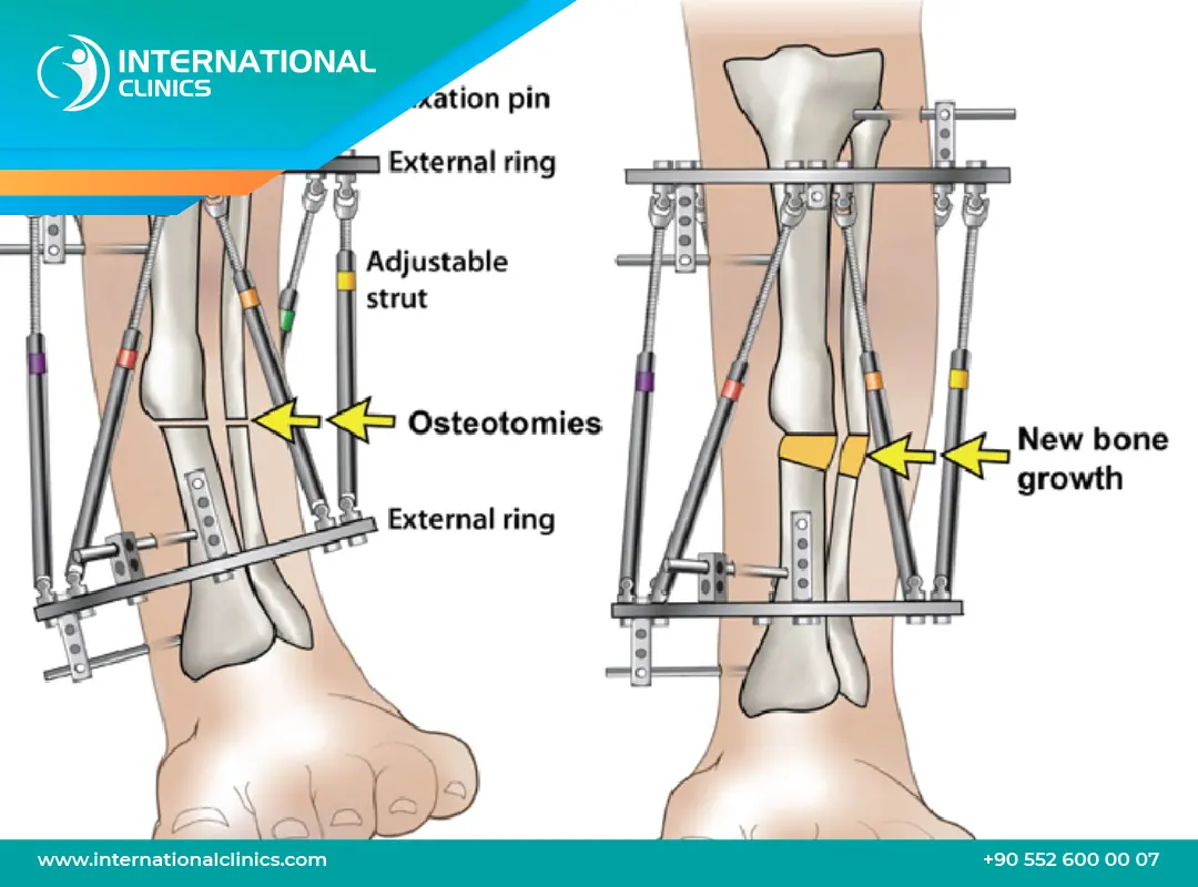ما هو جهاز إليزاروف؟ الاستخدامات، مدة التركيب، وكيفية العناية به