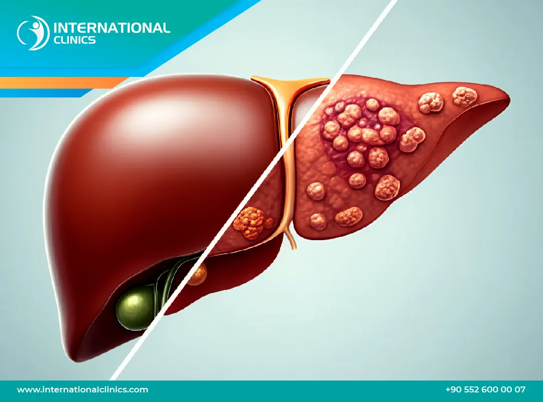 كم يعيش المريض بعد زراعة الكبد؟ نسب النجاح وعوامل إطالة العمر
