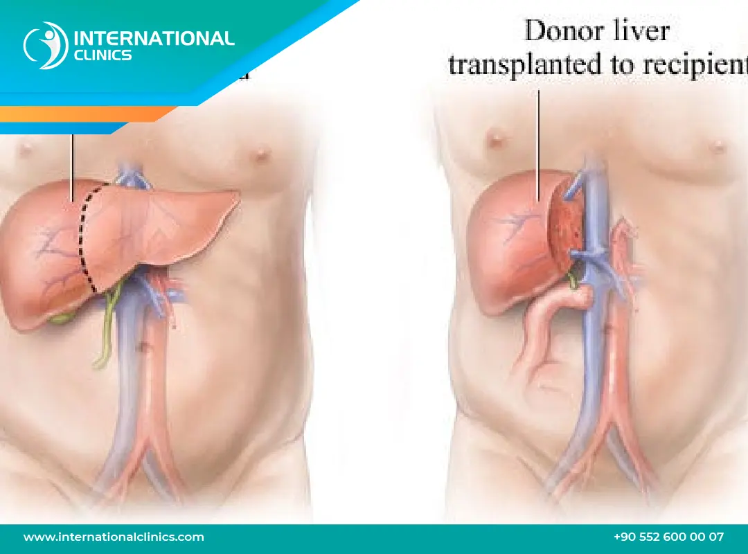 تجربتي مع زراعة الكبد | رحلة الأمل من التشخيص وحتى التعافي التام