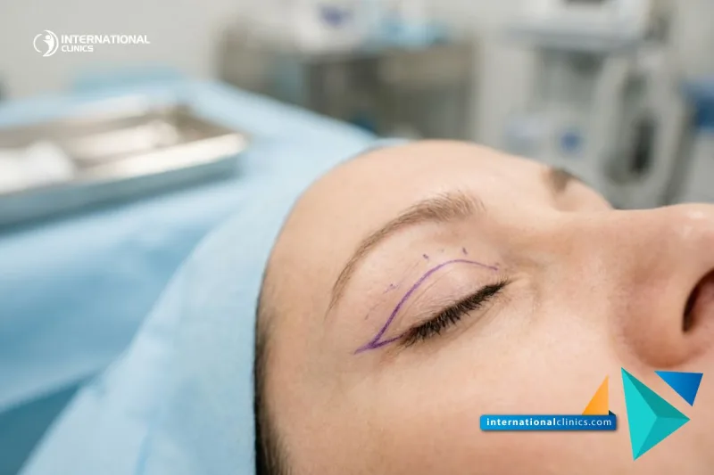 Close-up visual of surgical planning for Upper Eyelid Surgery Cost in Turkey at International Clinics