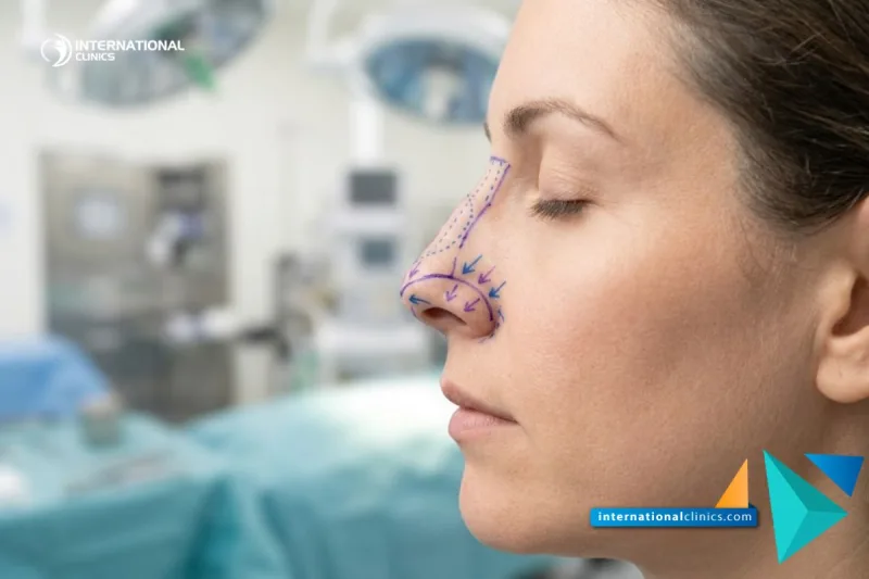 Réduction du Cartilage Nasal - Guide