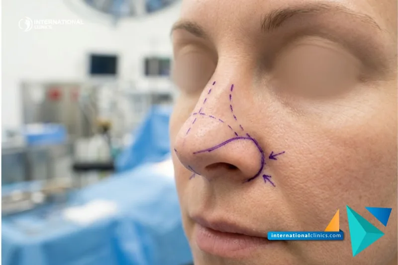 Close-up of a patient's lower nose marked with surgical planning lines for Alar Base Reduction in Turkey at International Clinics.