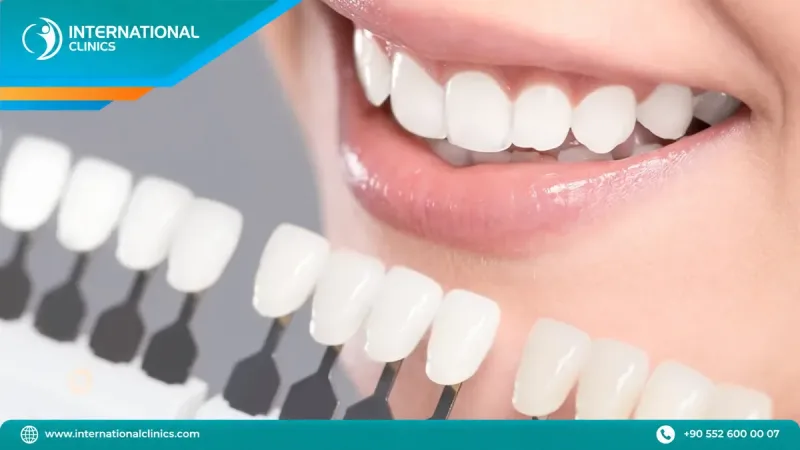 Dental shade guide held beside a patient smile during a composite bonding consultation in Istanbul