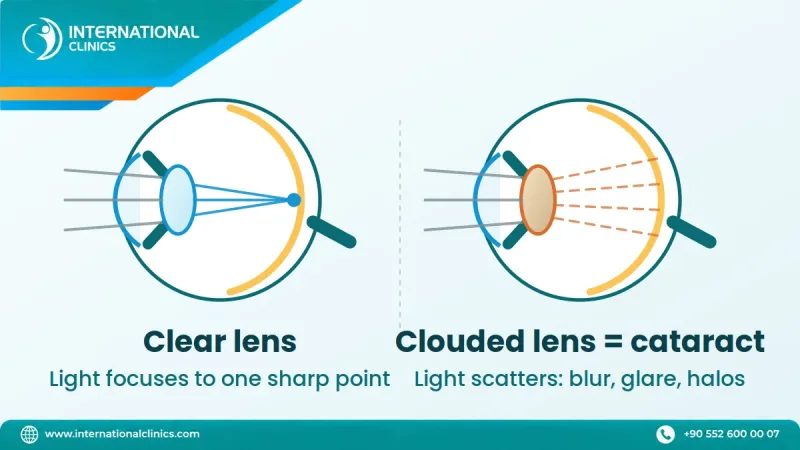 Diagram comparing a clear eye lens that focuses light with a lens clouded by a cataract that scatters it