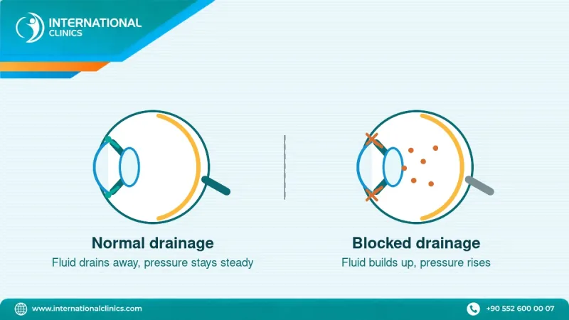 Diagram comparing normal eye drainage with blocked drainage that raises pressure in glaucoma